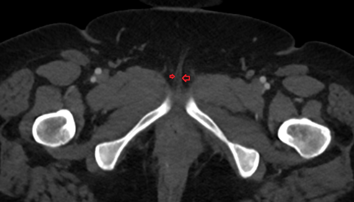 Ischiocavernosus muscle female   CT  axial  anatomy  image-img-00000-00000