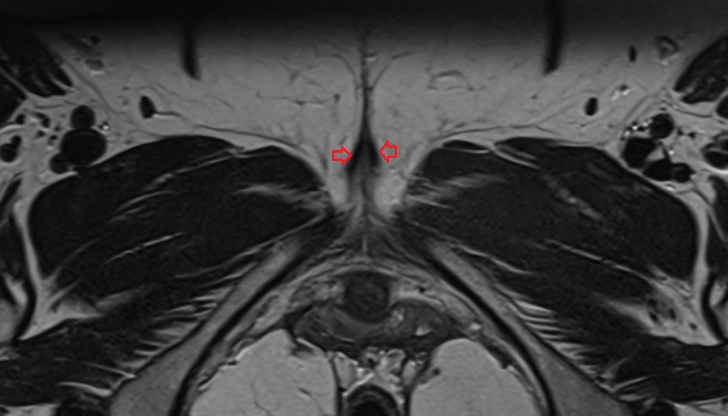 Ischiocavernosus muscle female    MRI  axial  anatomy  image-img-00000-00000_00001