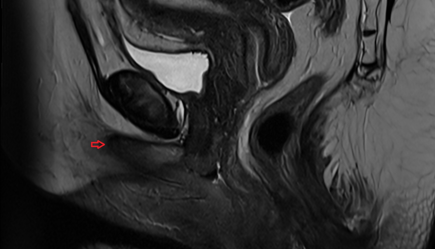Ischiocavernosus muscle female    MRI  sag  anatomy  image-img-00000-00000