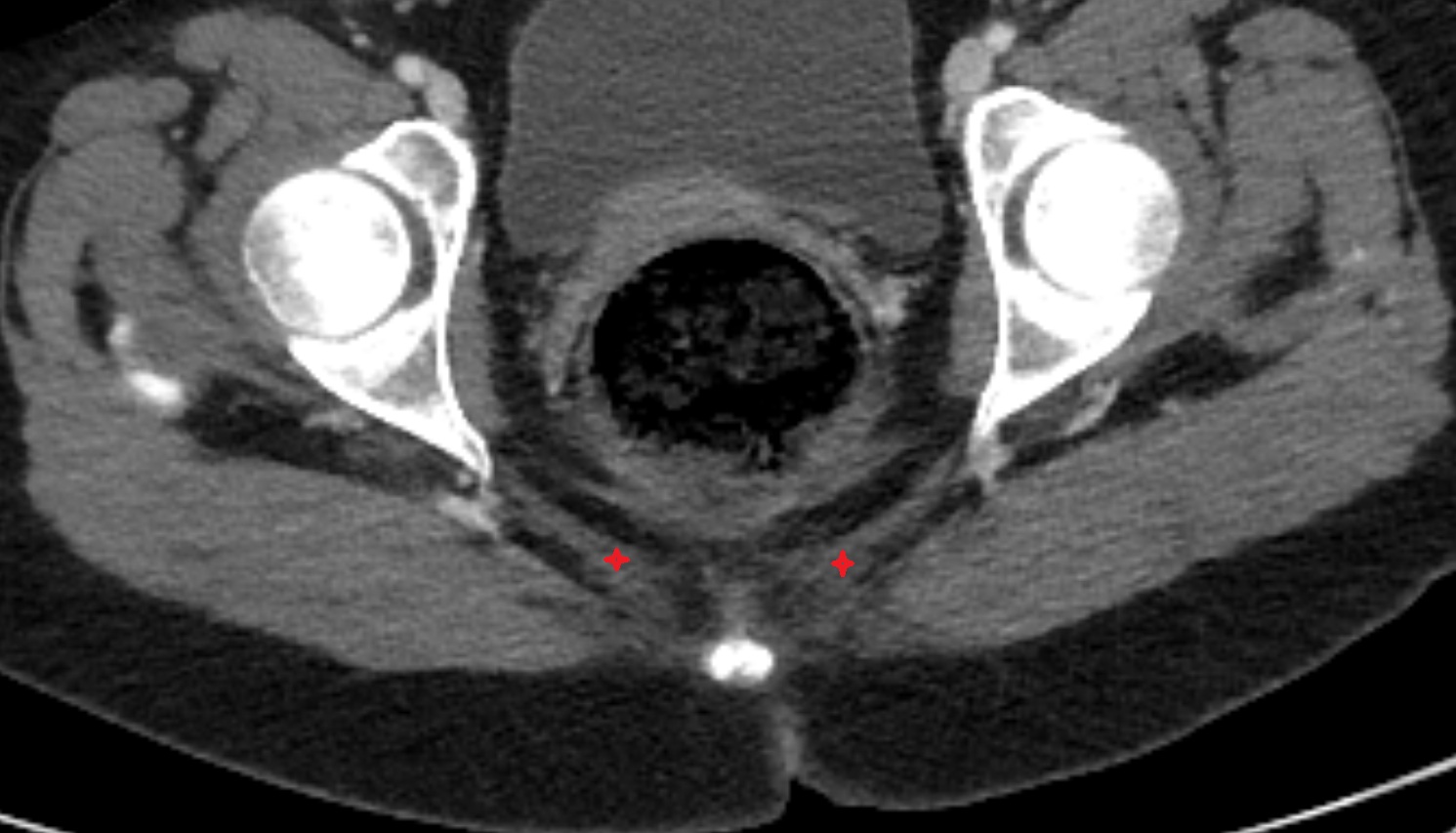 Ischiococcygeus muscle  CT  axial  anatomy  image-img-00000-00000