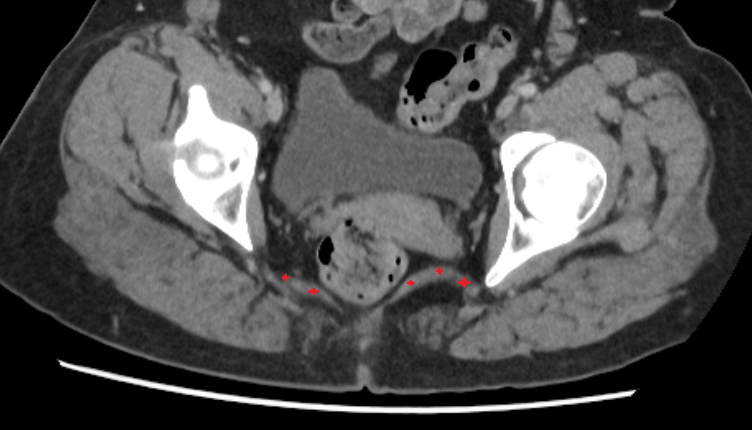Ischiococcygeus muscle  CT  axial  anatomy  image-img-00000-00000_00001