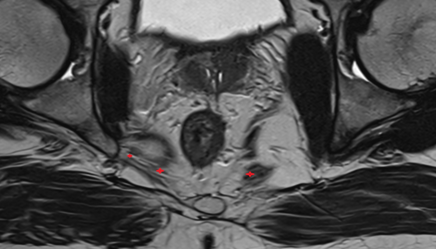 Ischiococcygeus muscle  MRI  axial  anatomy  image-img-00000-00000