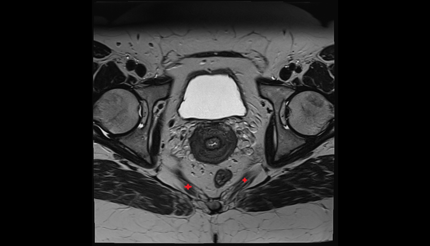 Ischiococcygeus muscle  MRI  axial  anatomy  image-img-00000-00000_00001