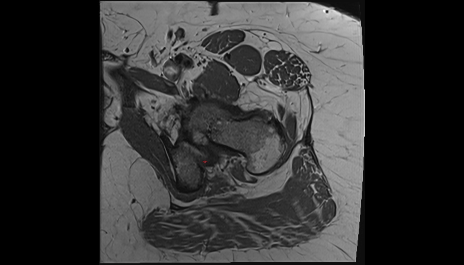 Ischiofemoral ligament  MRI axial  anatomy image-img-00000-00000