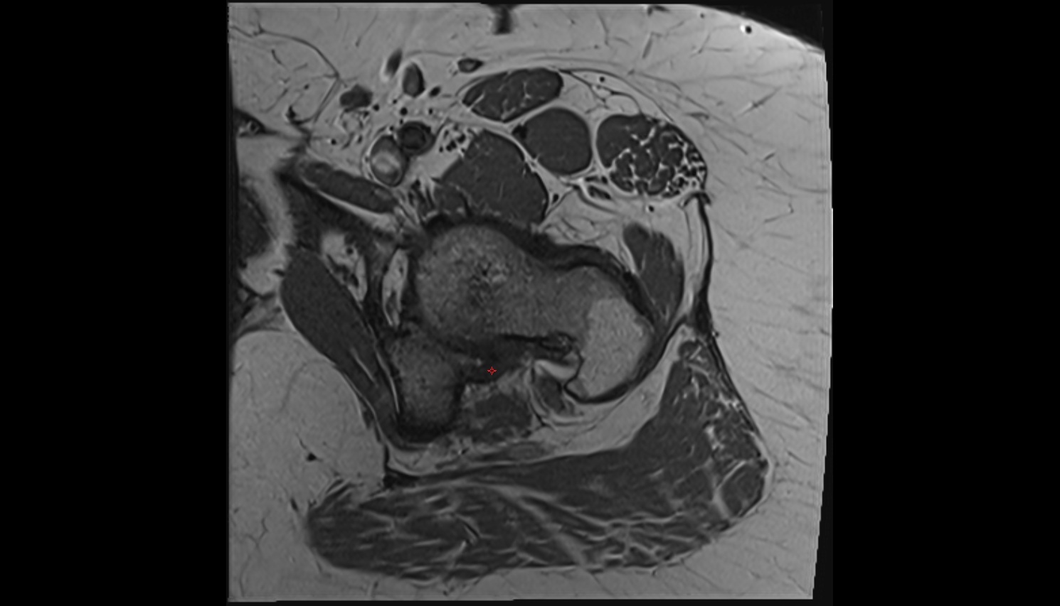 Ischiofemoral ligament  MRI axial  anatomy image-img-00000-00000_00001