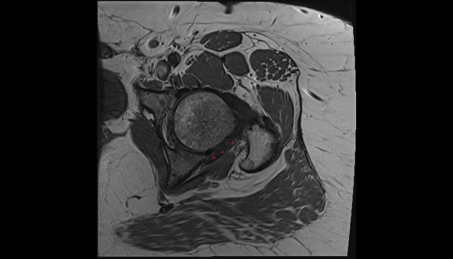Ischiofemoral ligament  MRI axial  anatomy image-img-00000-00000_00002