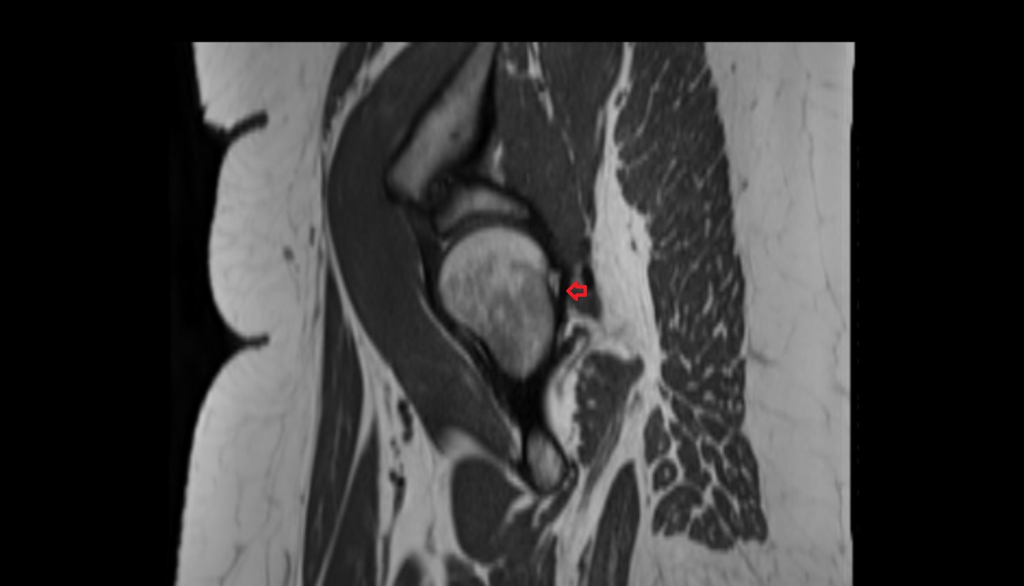 Ischiofemoral ligament  MRI sag  anatomy image-img-00000-00000