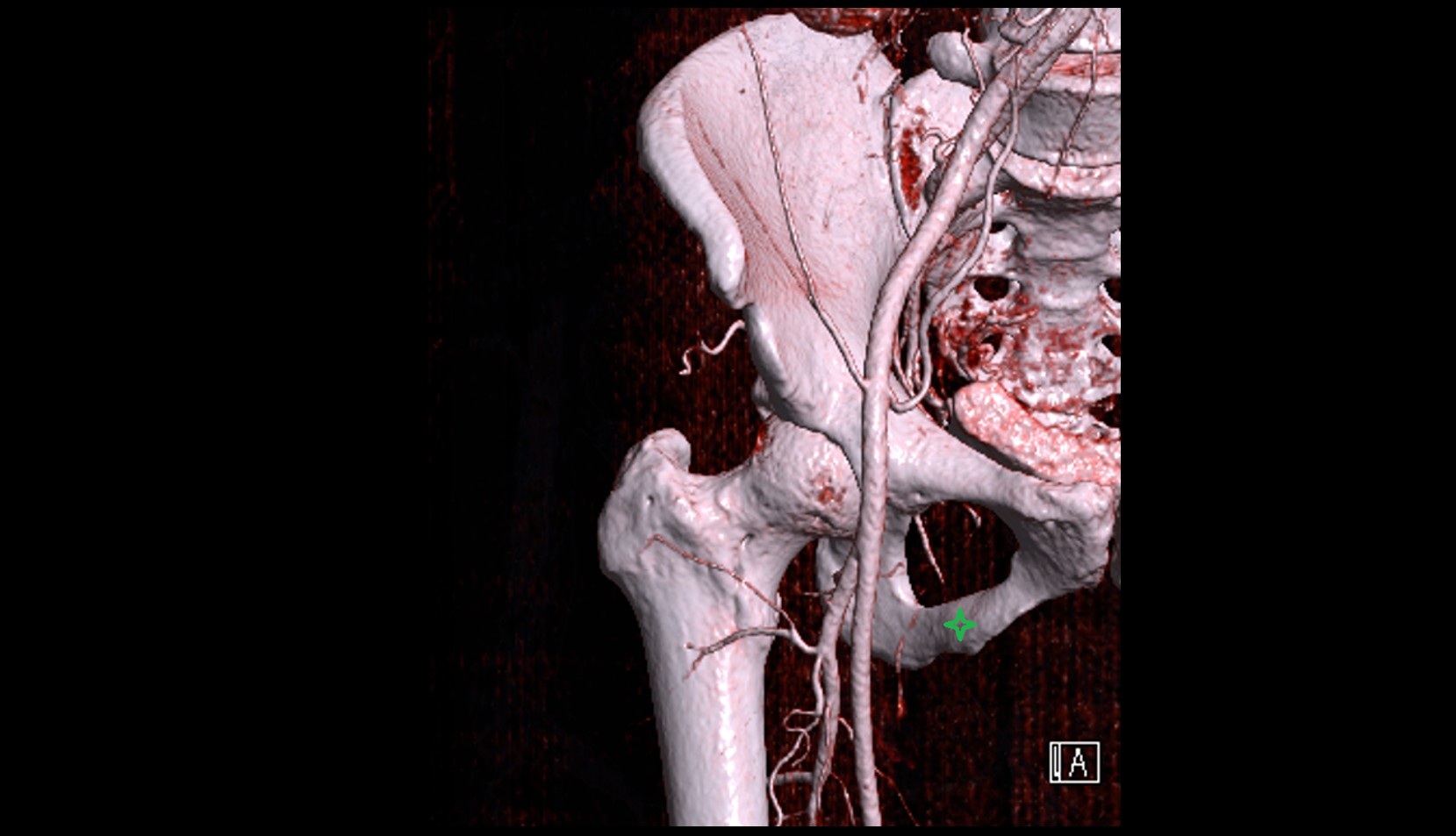 Ischiopubic ramus 3d ct image