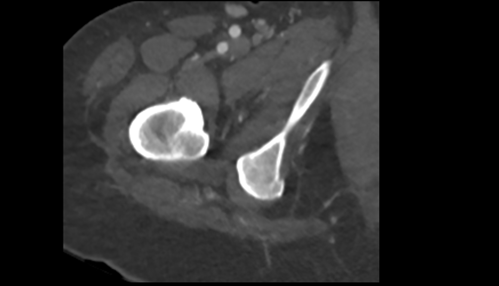 Ischiopubic ramus ct axial