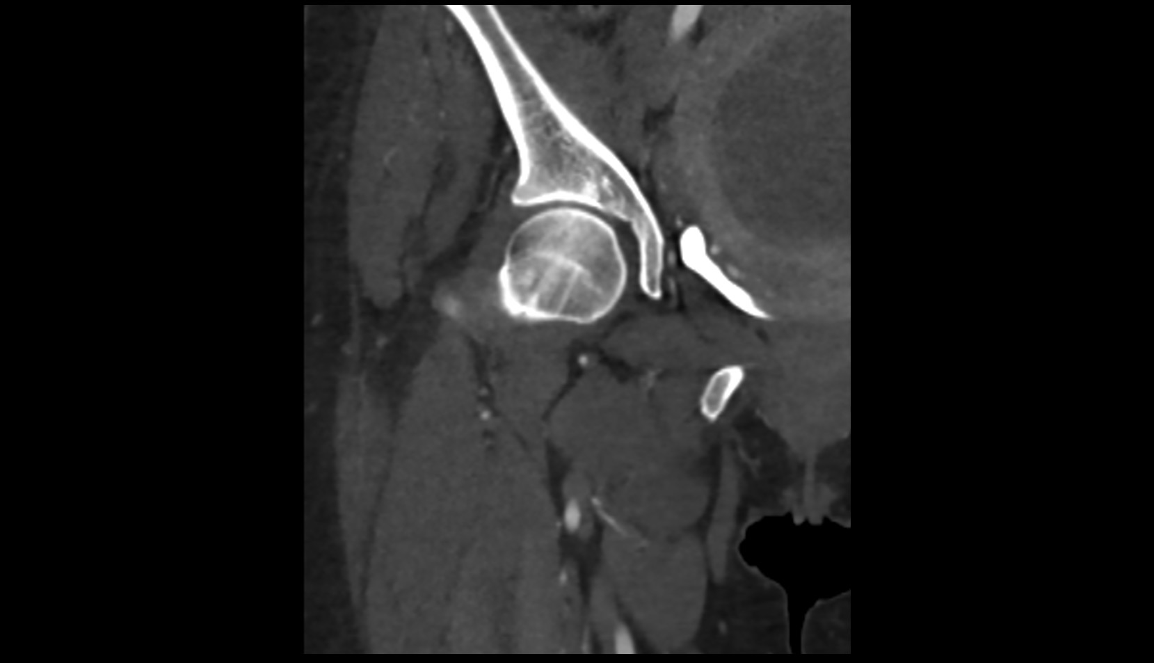 Ischiopubic ramus ct coronal