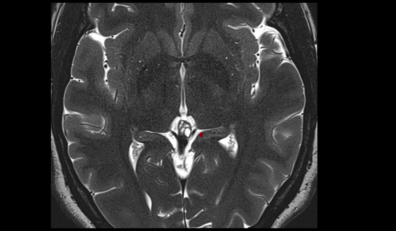 Isthmus of cingulate gyrus mri 3t axial image