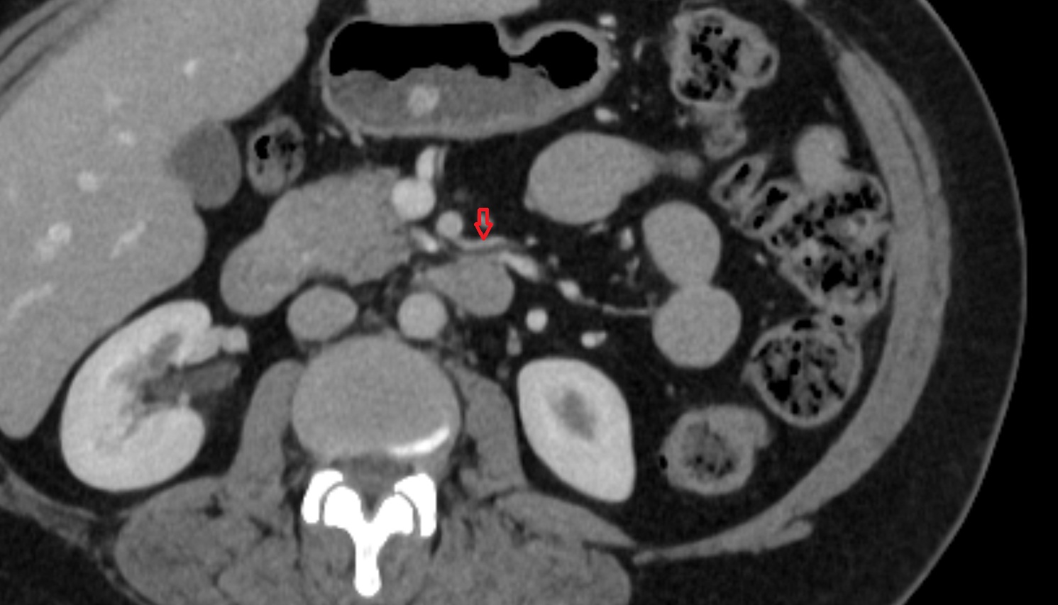 Jejunal arteries CT axial anatomy  image -img-00000-00000