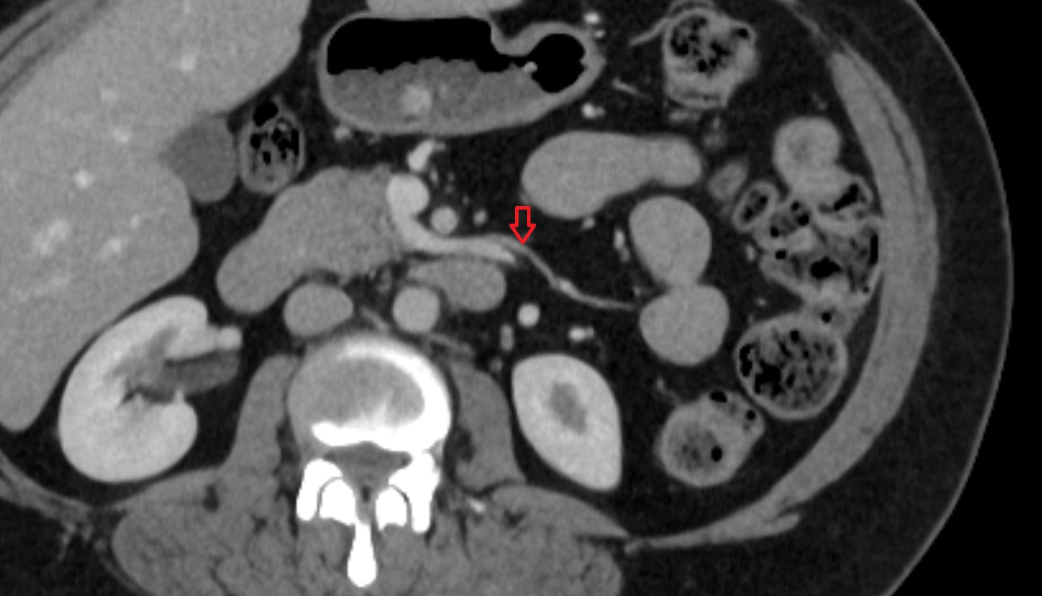 Jejunal arteries CT axial anatomy  image -img-00000-00000_00001