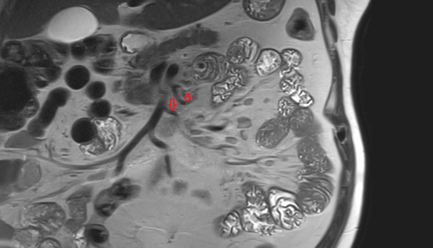 Jejunal arteries MRI coronal anatomy  image -img-00000-00000