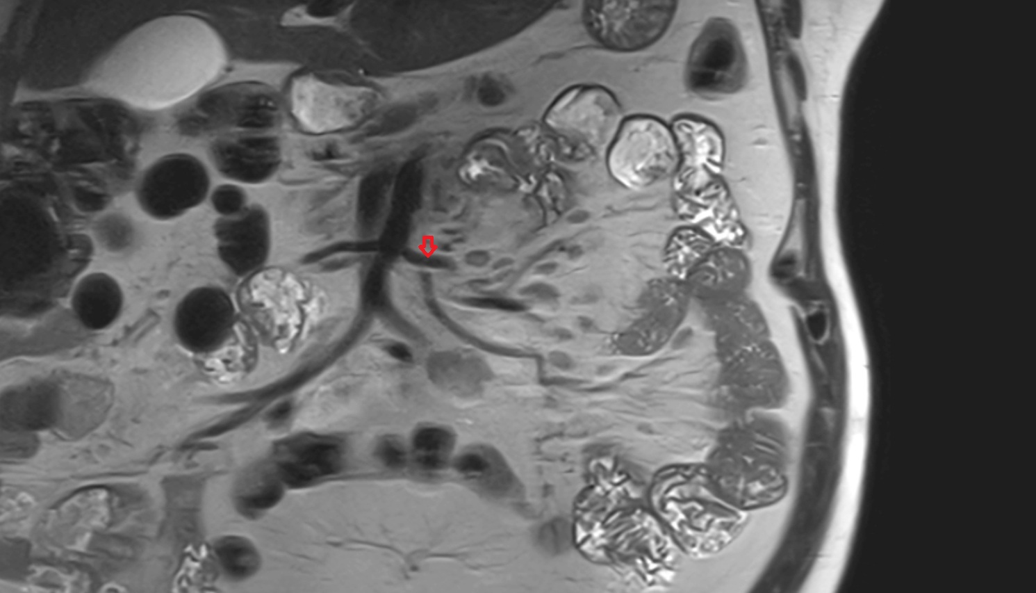 Jejunal arteries MRI coronal anatomy  image -img-00000-00000_00001
