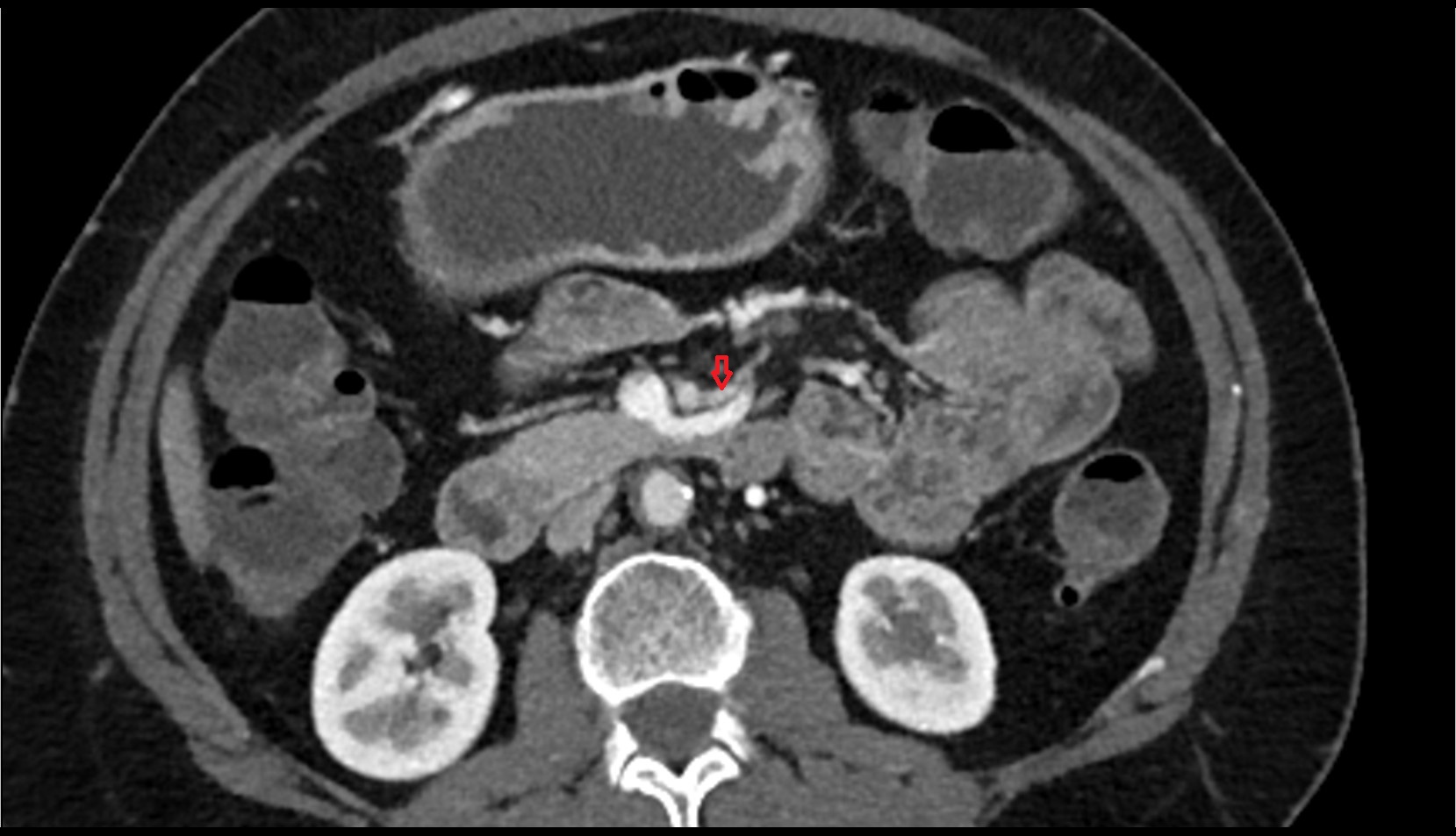 Jejunal arteries ct axial image
