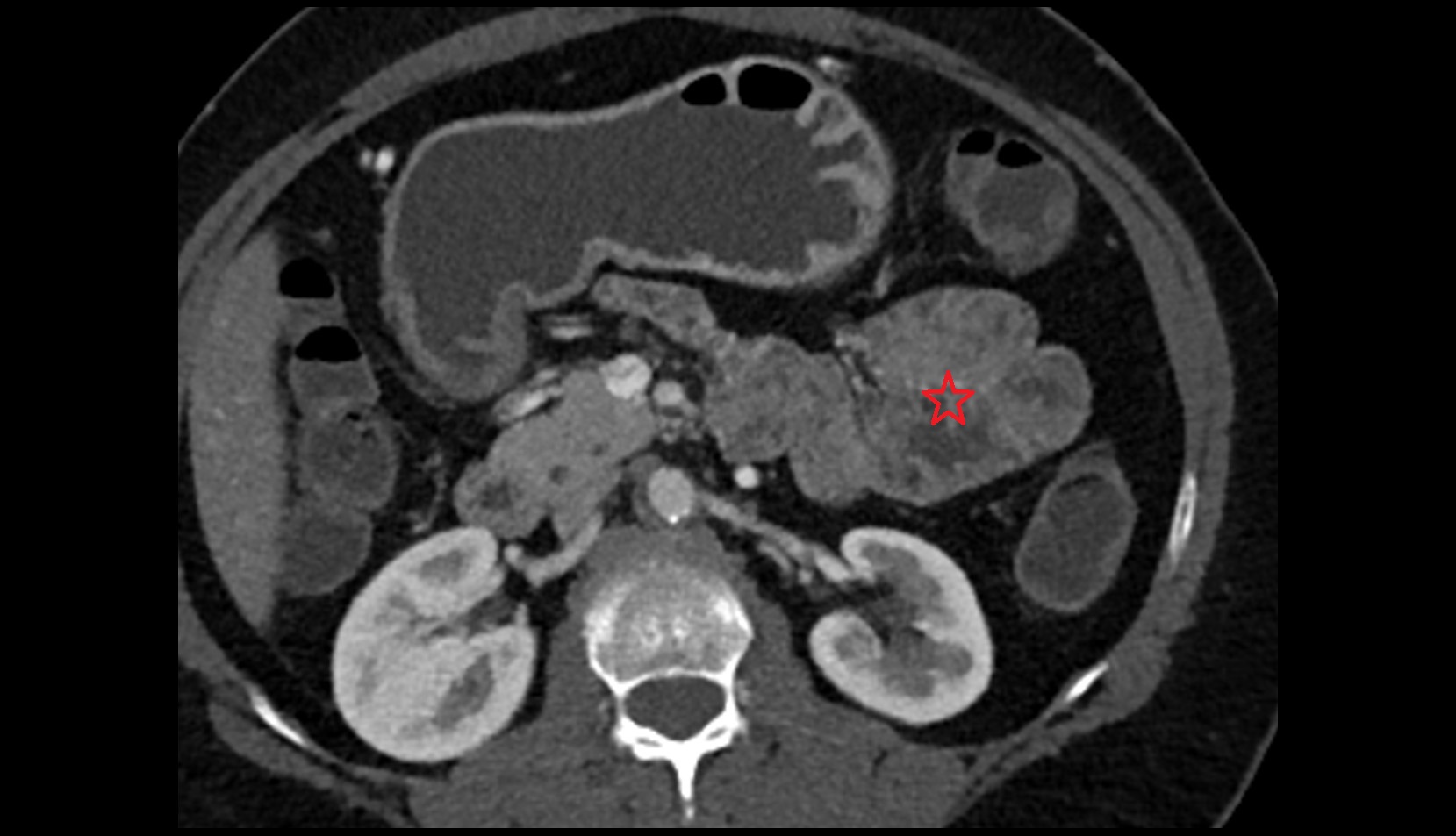 Jejunum CT axial image