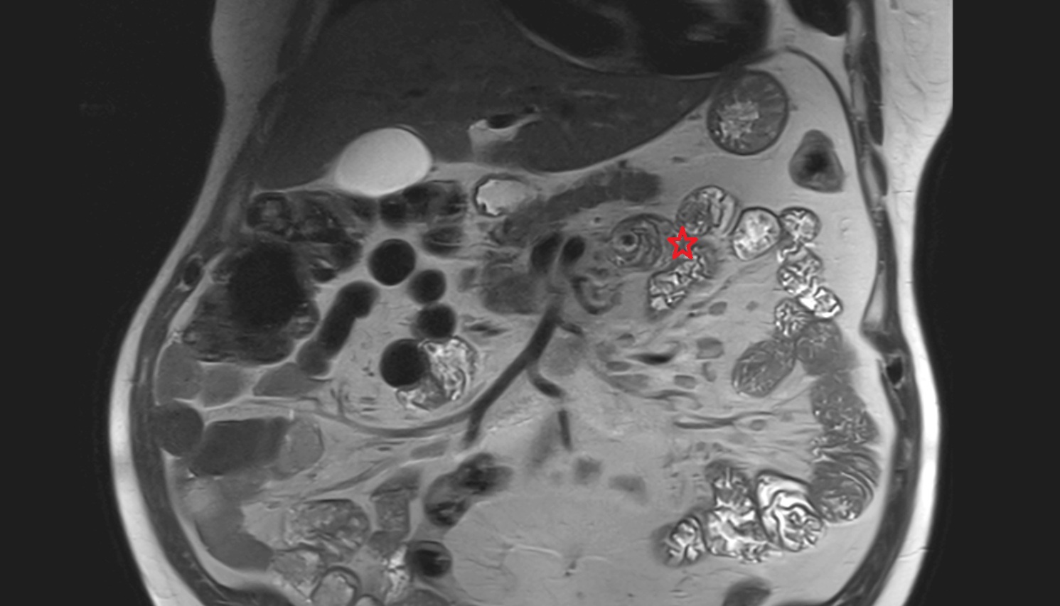 Jejunum  MRI coronal  anatomy  image -img-00000-00000