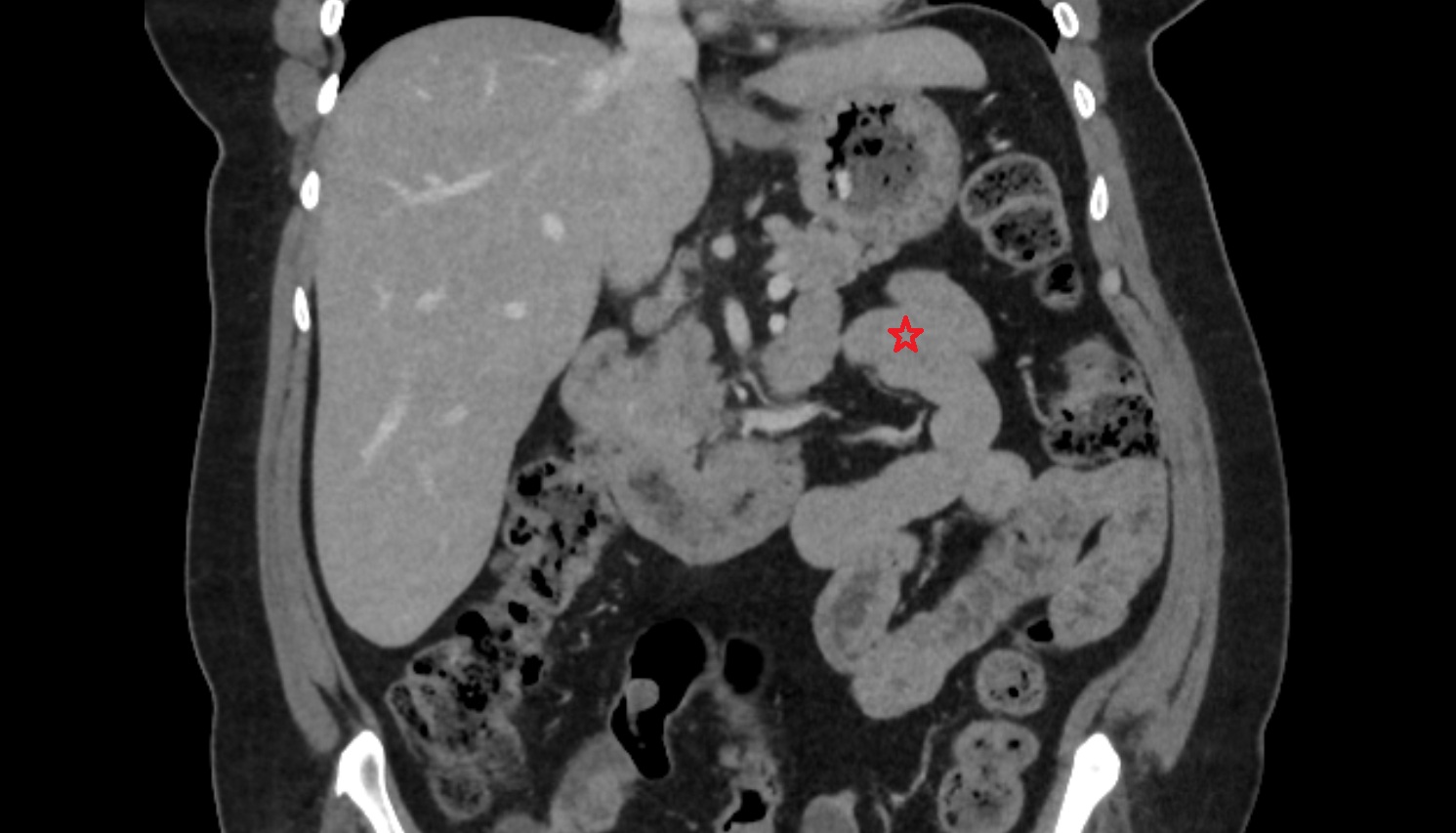 Jejunum  ct coronal  anatomy  image -img-00000-00000