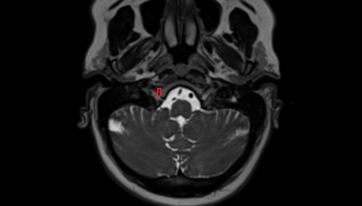 Jugular Foramen Pars Nervosa-img-00000-00000