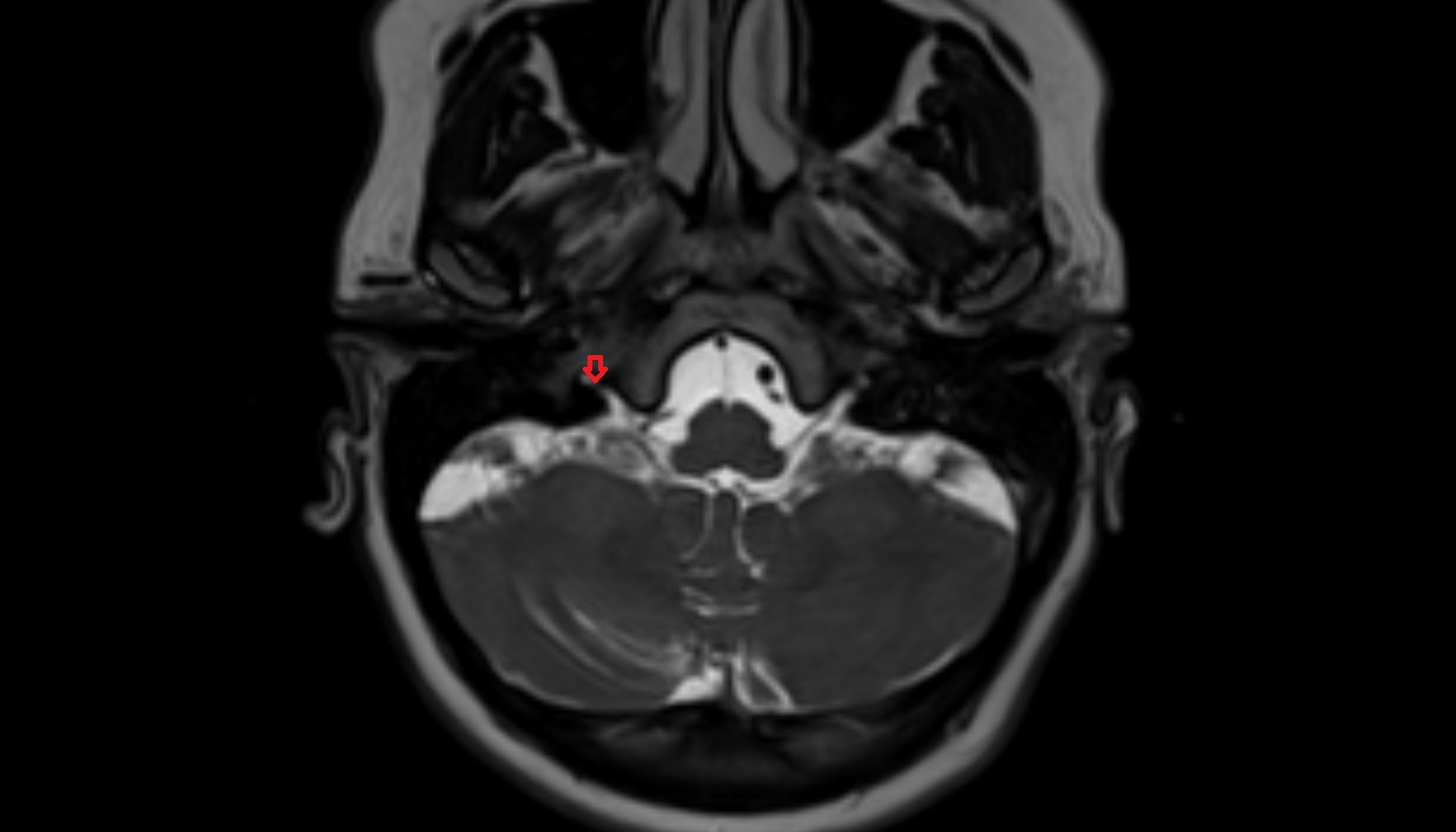 Jugular foramen mri image-img-00000-00000
