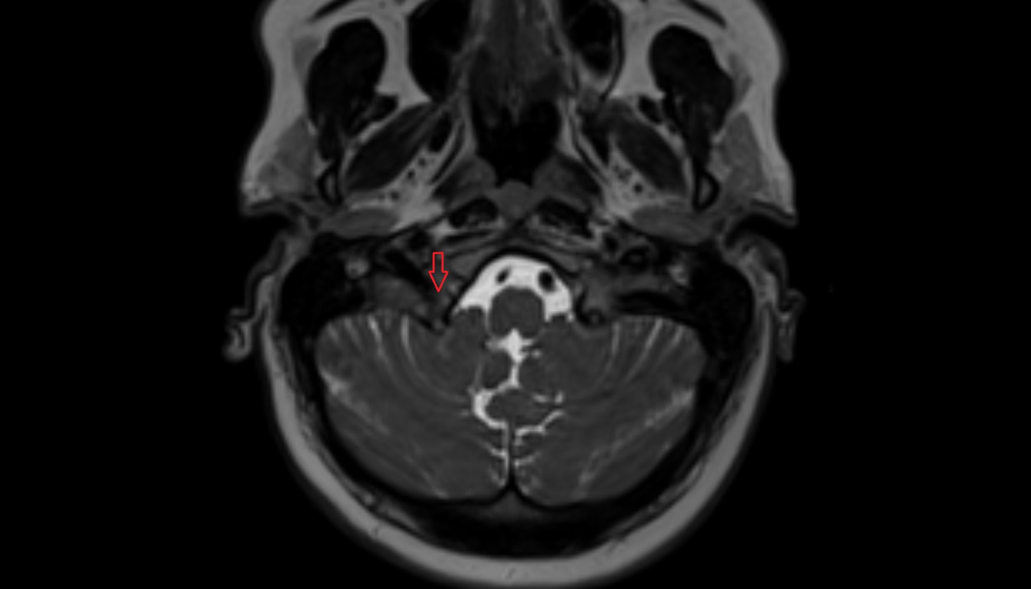 Jugular foramen pars vascularis-img-00000-00000
