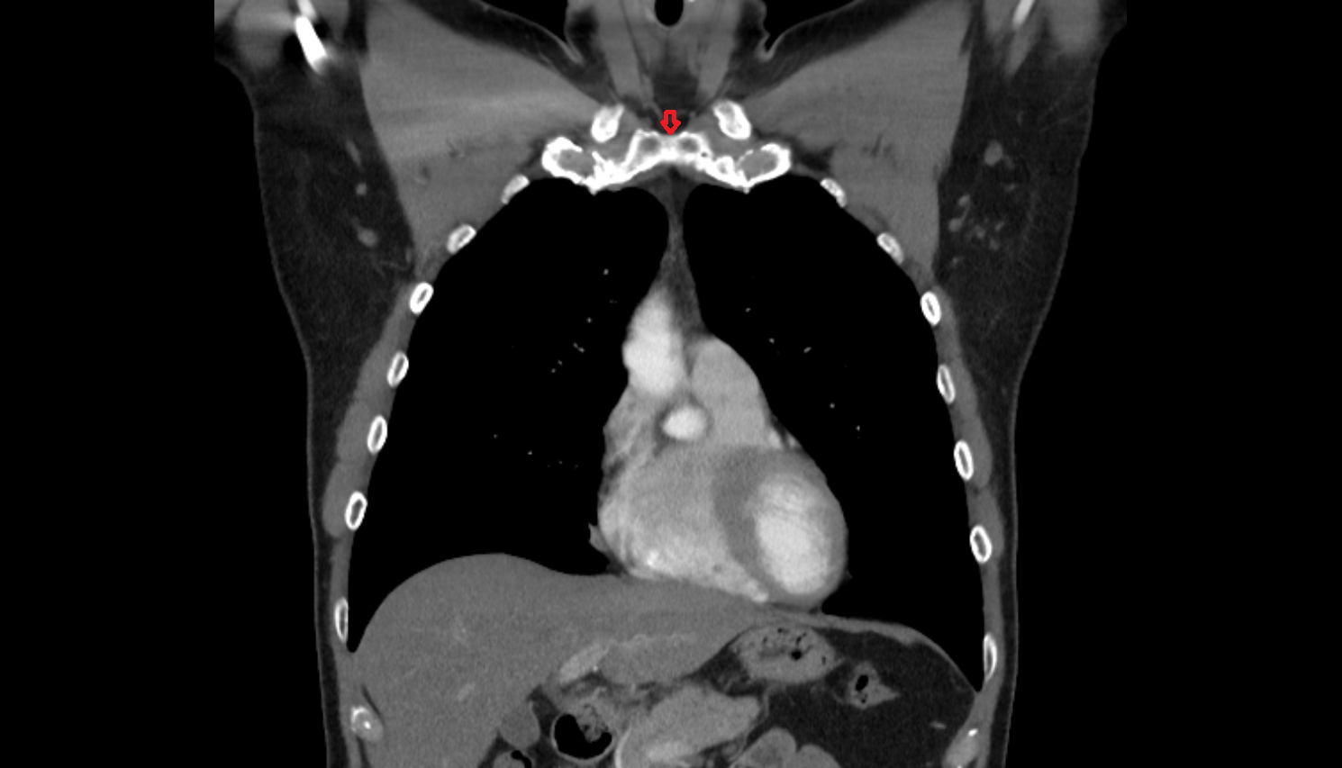 Jugular notch coronal CT  image-img-00000-00000