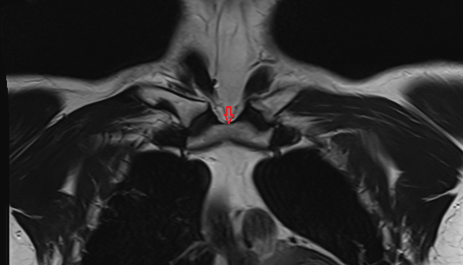 Jugular notch coronal MRI  image-img-00000-00000
