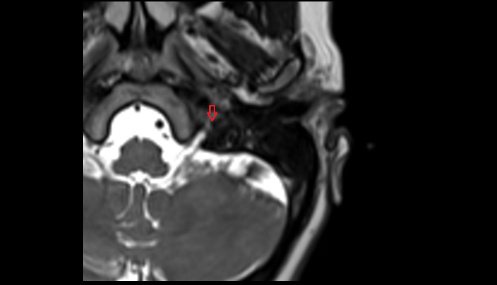 Jugular spine mri axial image