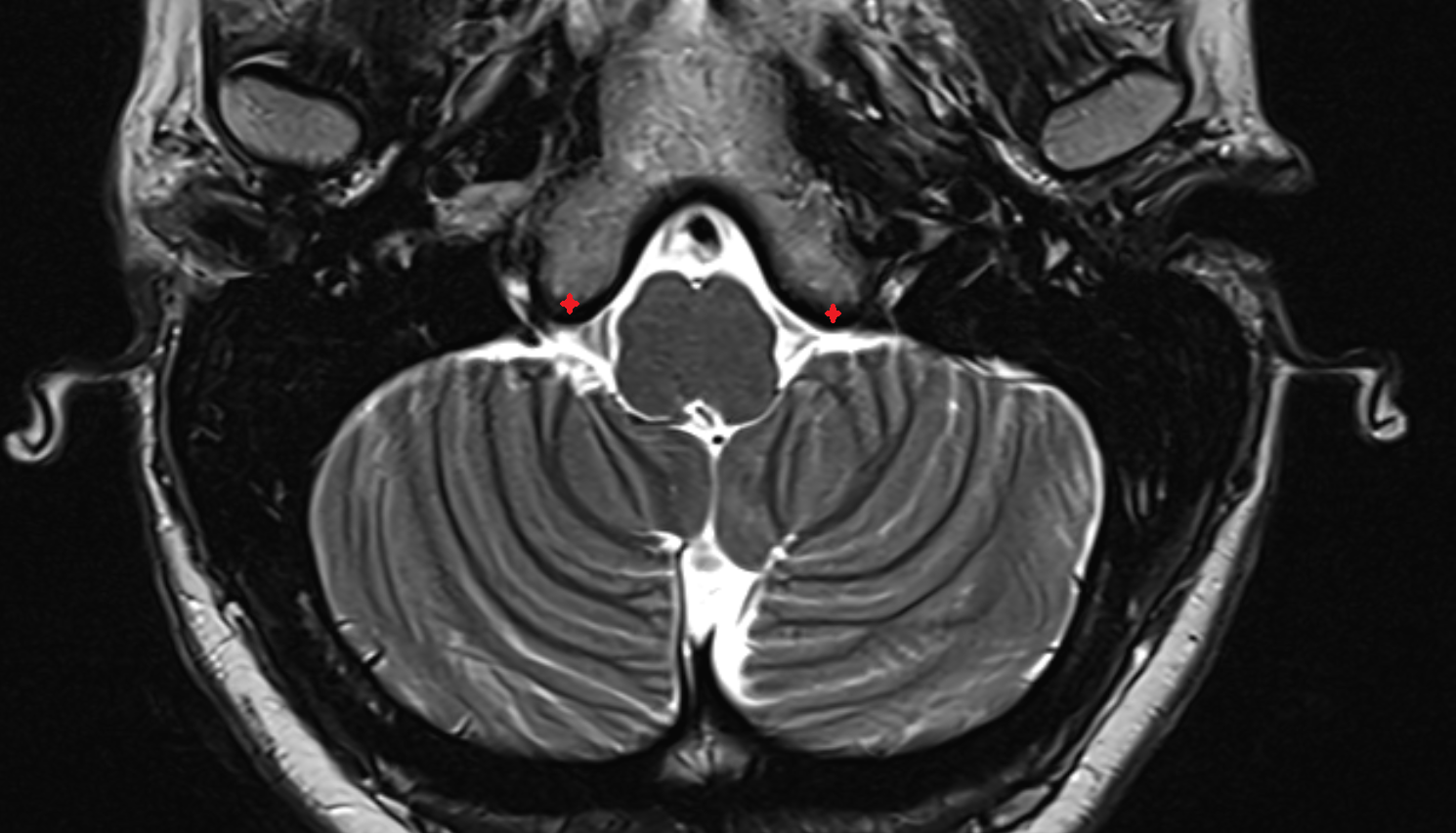 Jugular tubercle  mri axial  image-img-00000-00000