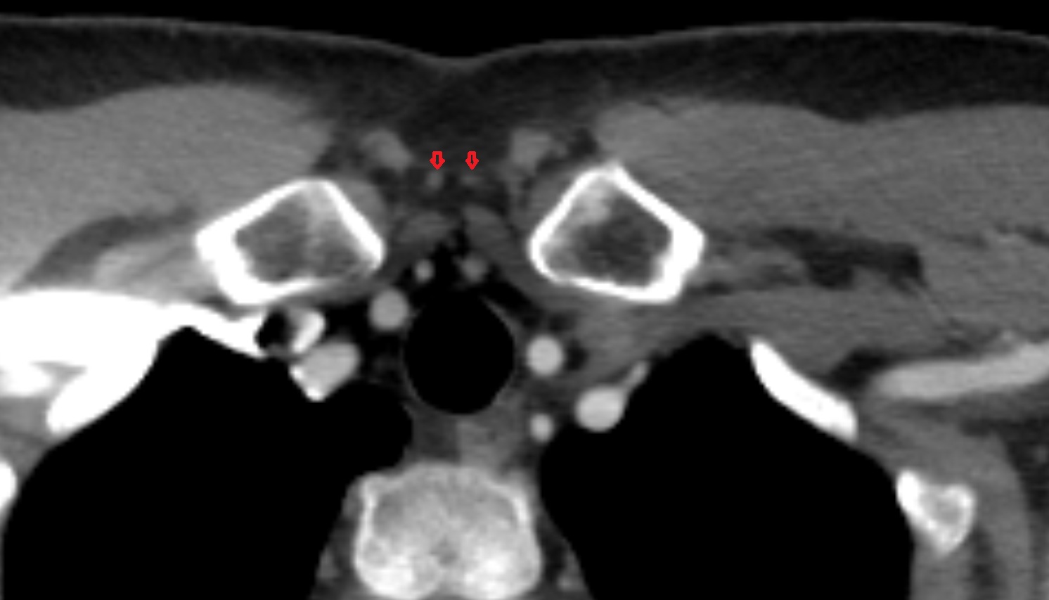 Jugular venous arch anatomy axial ct  image -img-00000-00000