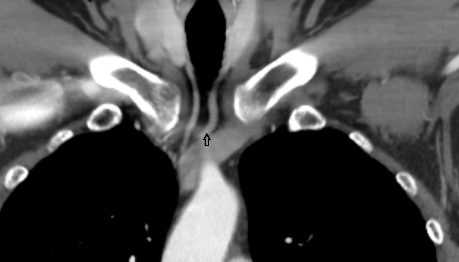 Jugular venous arch anatomy coronal ct  image -img-00000-00000