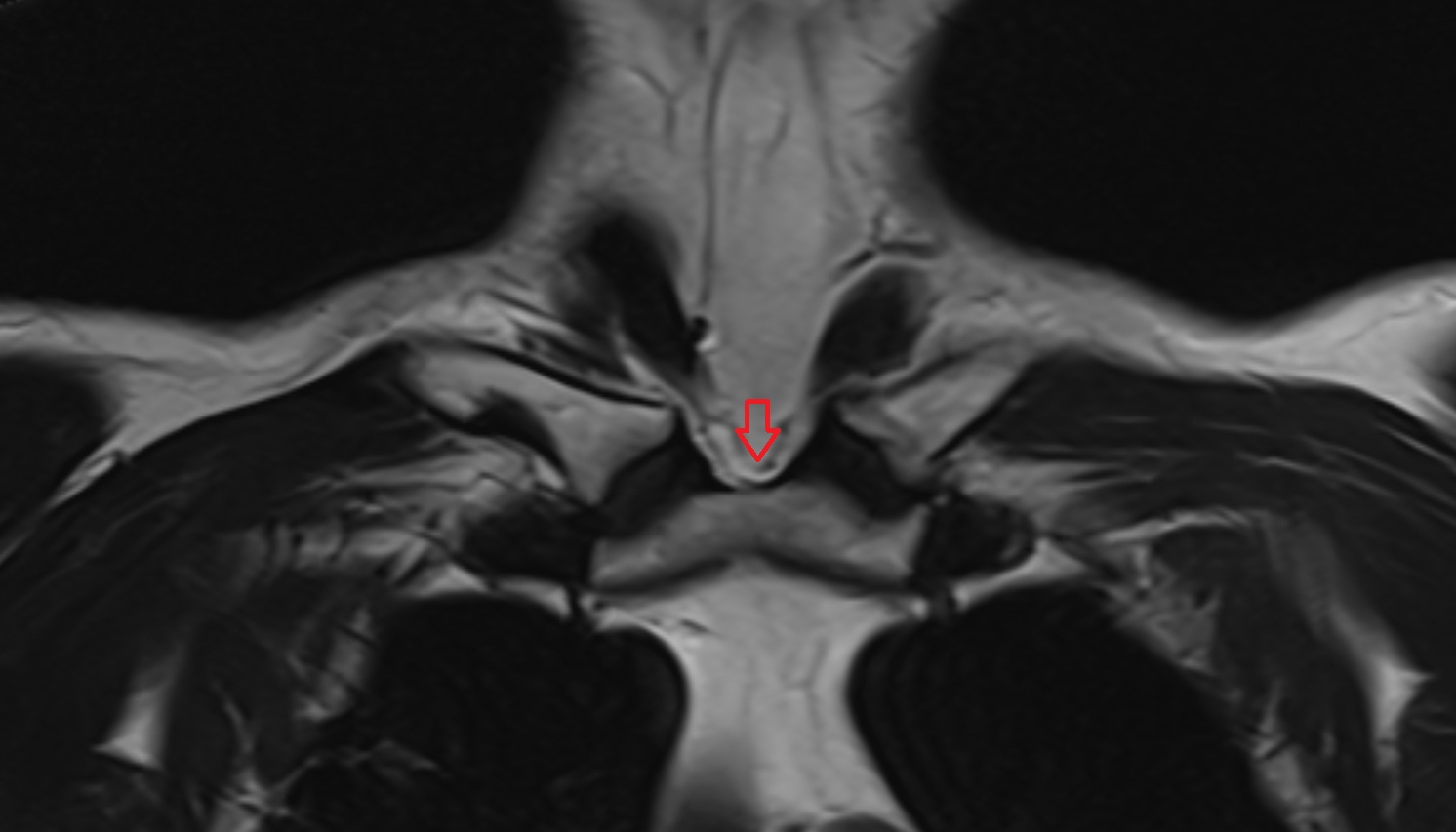 Jugular venous arch anatomy coronal mri  image -img-00000-00000