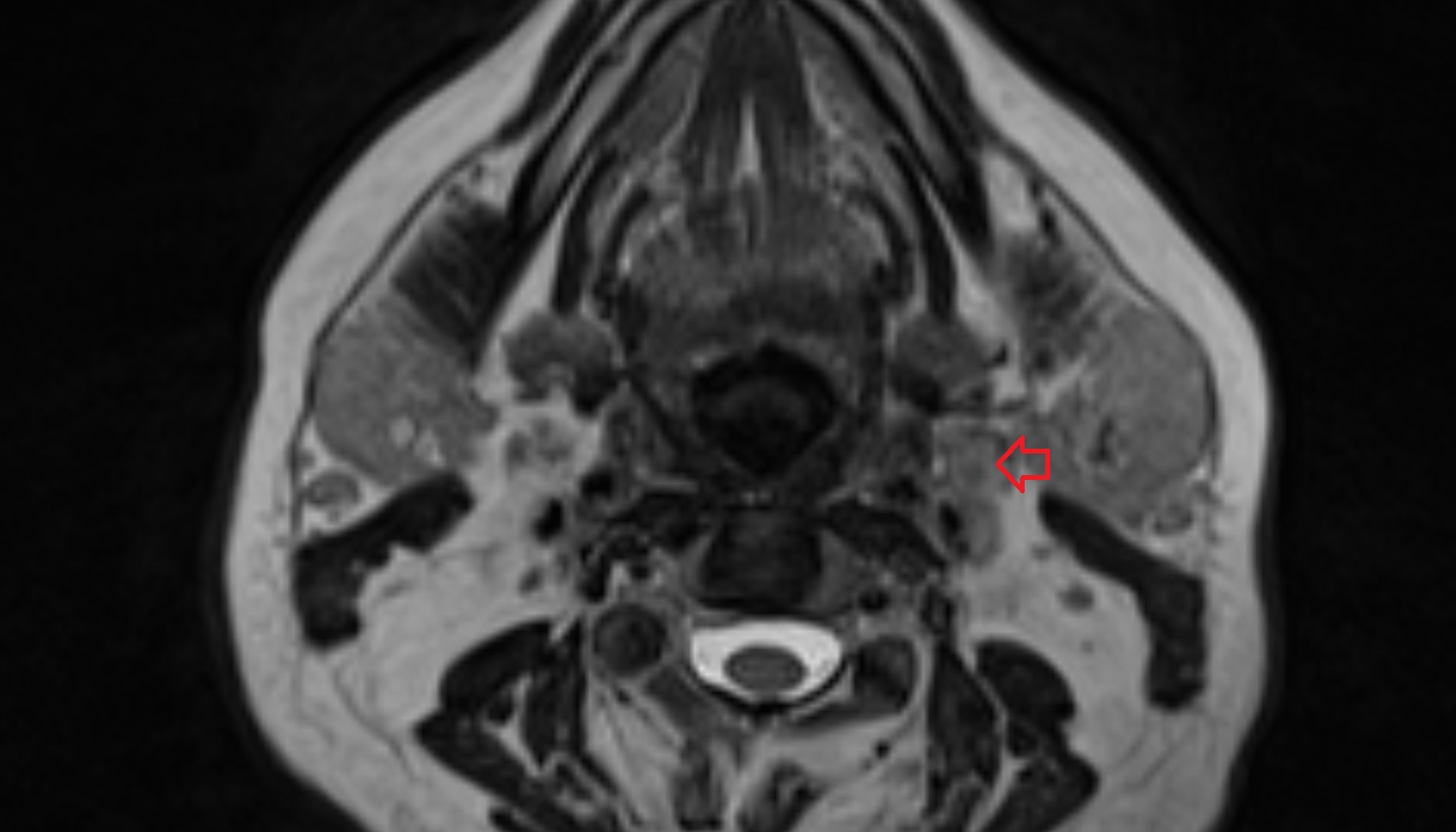 Jugulodigastric lymph nodes mri axial  image -img-00000-00000