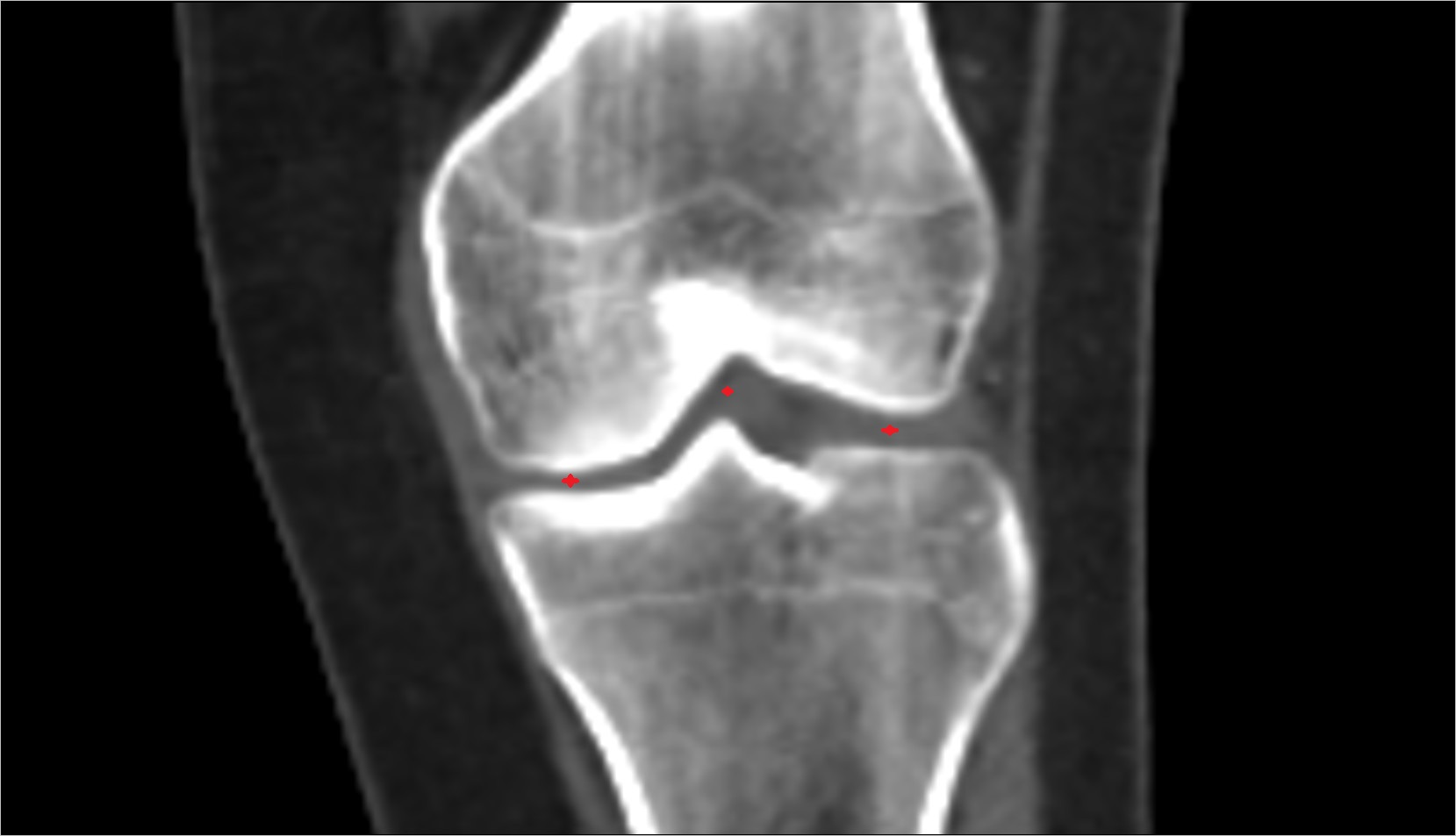 Knee Joint Anatomy ct coronal