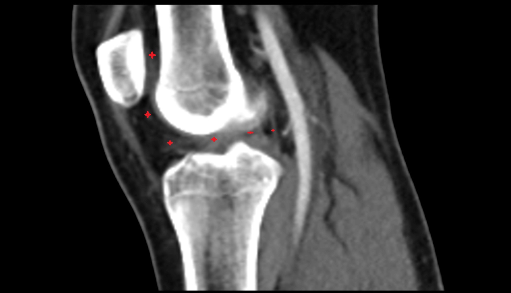 Knee Joint Anatomy ct sagttal image