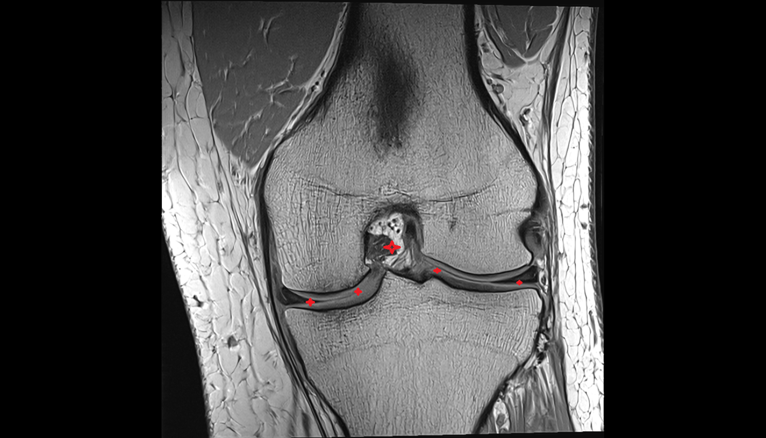 Knee Joint  coronal cross sectional anatomy 3T MRI AI enhanced  radiology  anatomy image-img-00000-00000