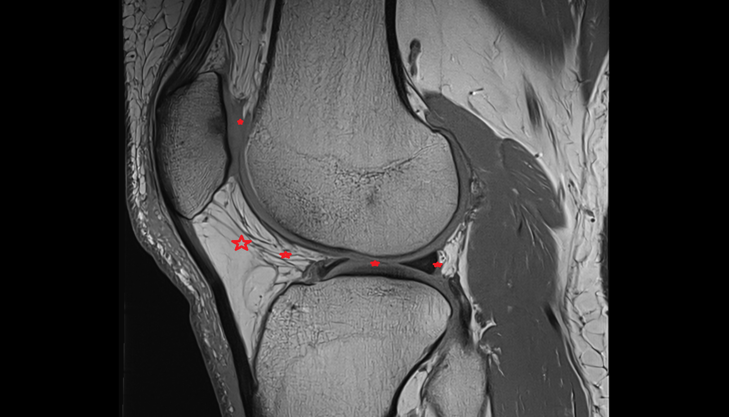 Knee Joint  sagittal  cross sectional anatomy 3T MRI AI enhanced  radiology  anatomy image-img-00000-00000