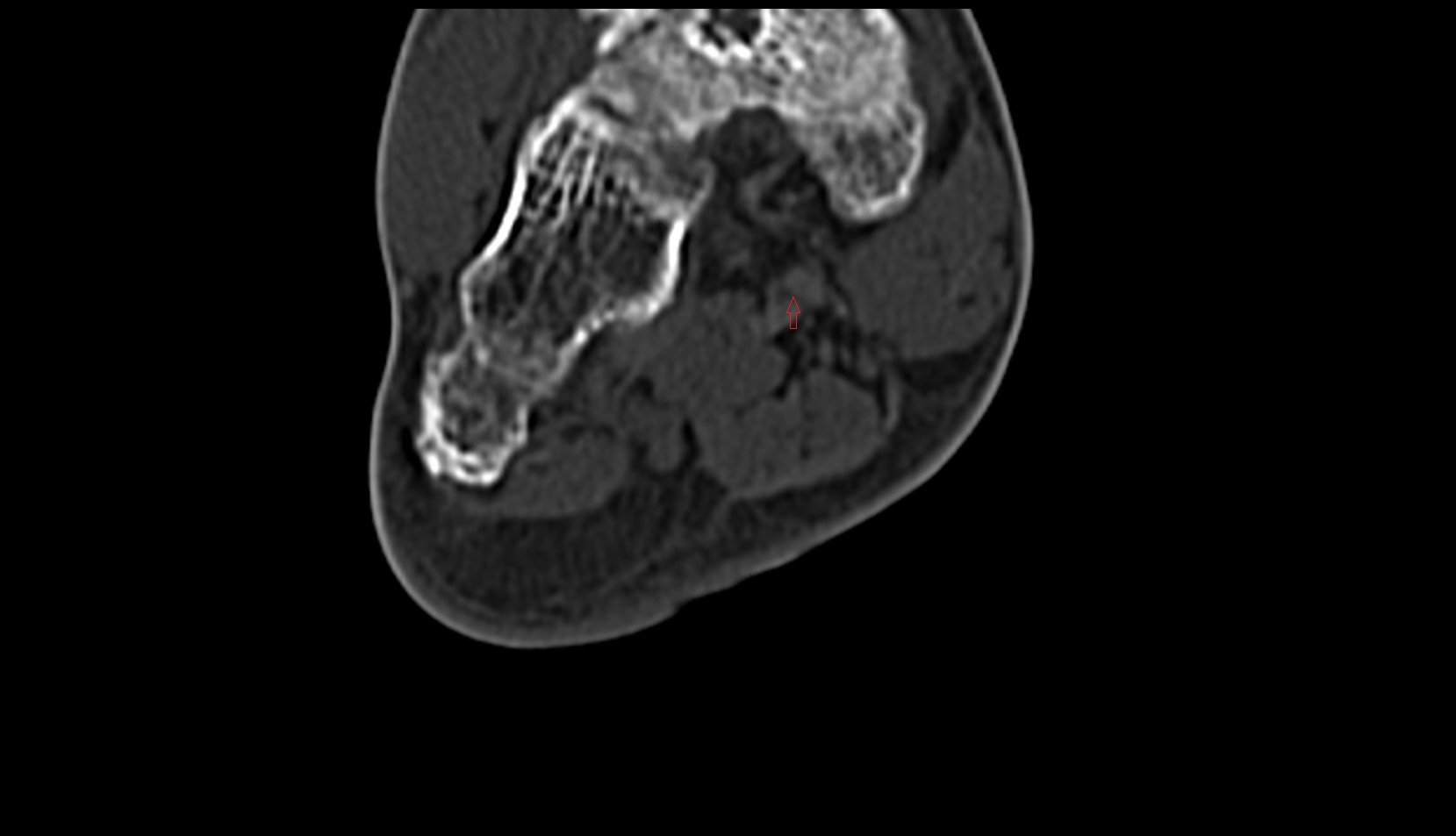 Knot of Henry ct axial image