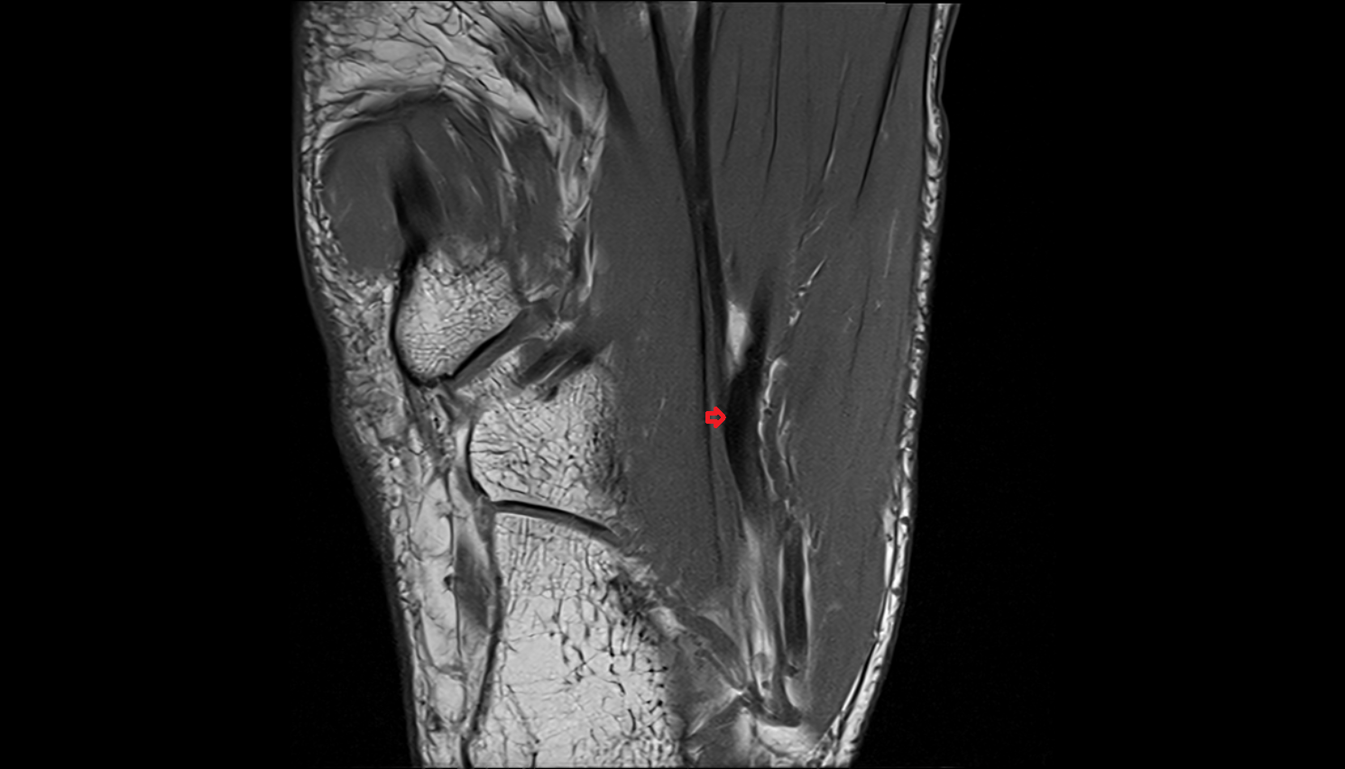 Knot of Henry  of the Foot  axial cross sectional anatomy 3T MRI AI enhanced radiology image-img-00000-00000