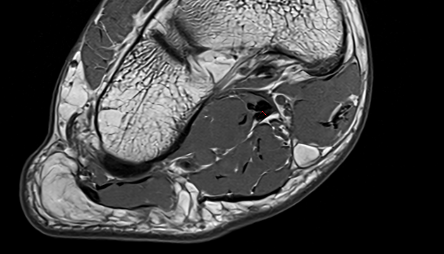 Knot of Henry  of the Foot  axial cross sectional anatomy 3T MRI AI enhanced radiology image-img-00000-00000_00001