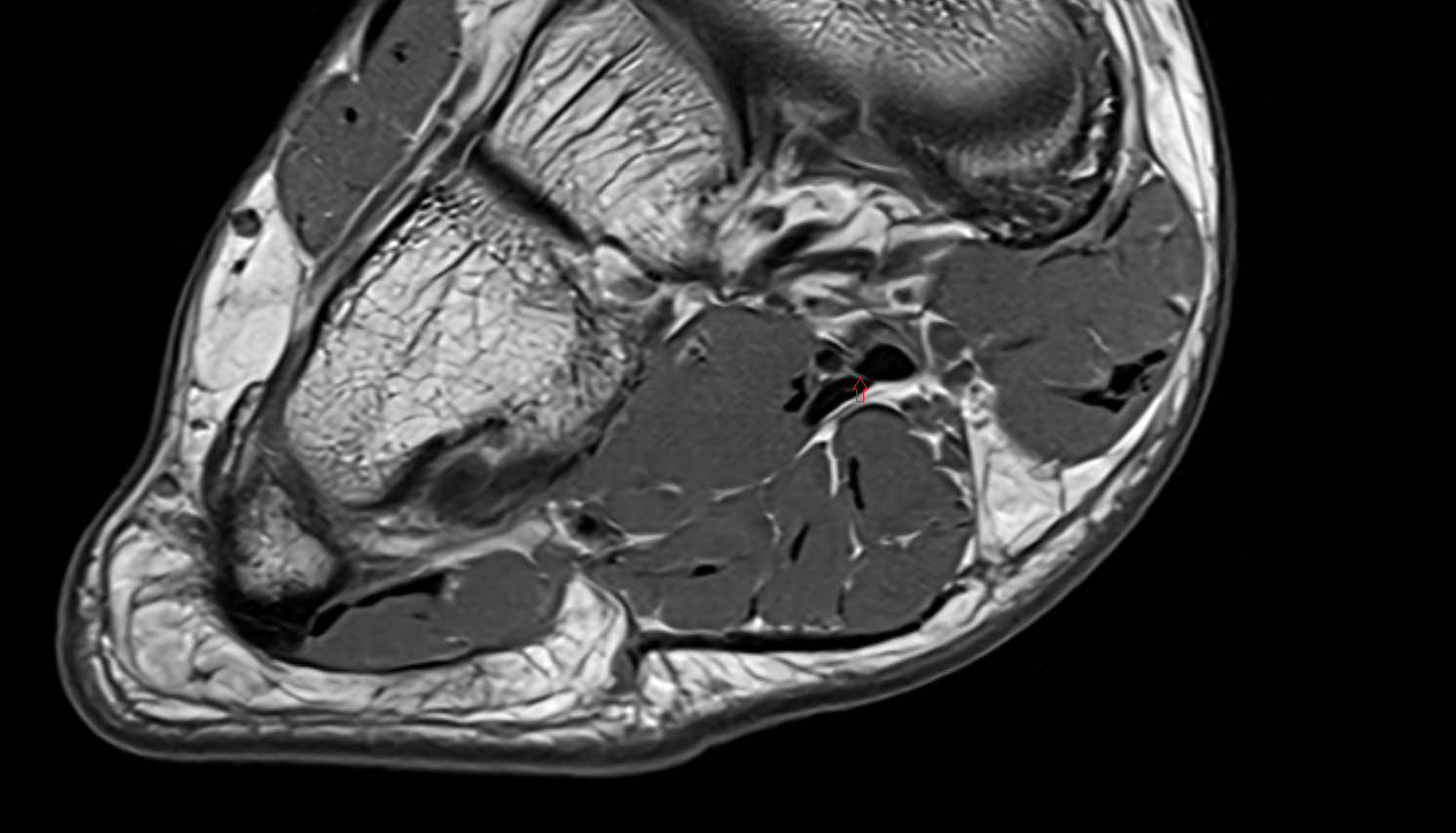 Knot of Henry  of the Foot  axial cross sectional anatomy 3T MRI AI enhanced radiology image-img-00000-00000_00002