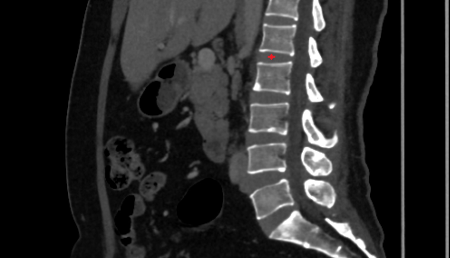 L1–L2  Intervertebral Disc  CT sagittal  anatomy  image-img-00000-00000