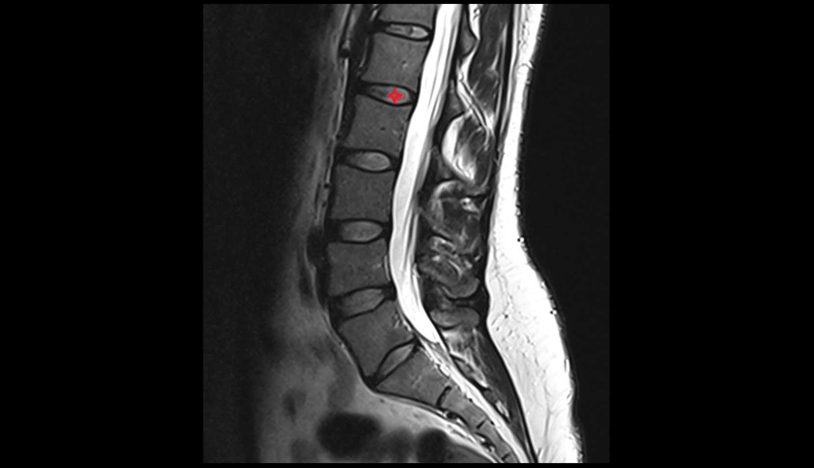L1–L2 Intervertebral Disc mri anatomy  image