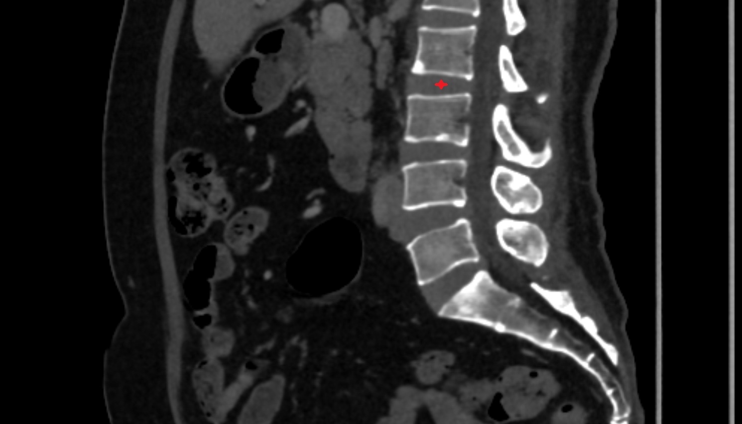 L2–L3  Intervertebral Disc  CT sagittal  anatomy  image-img-00000-00000