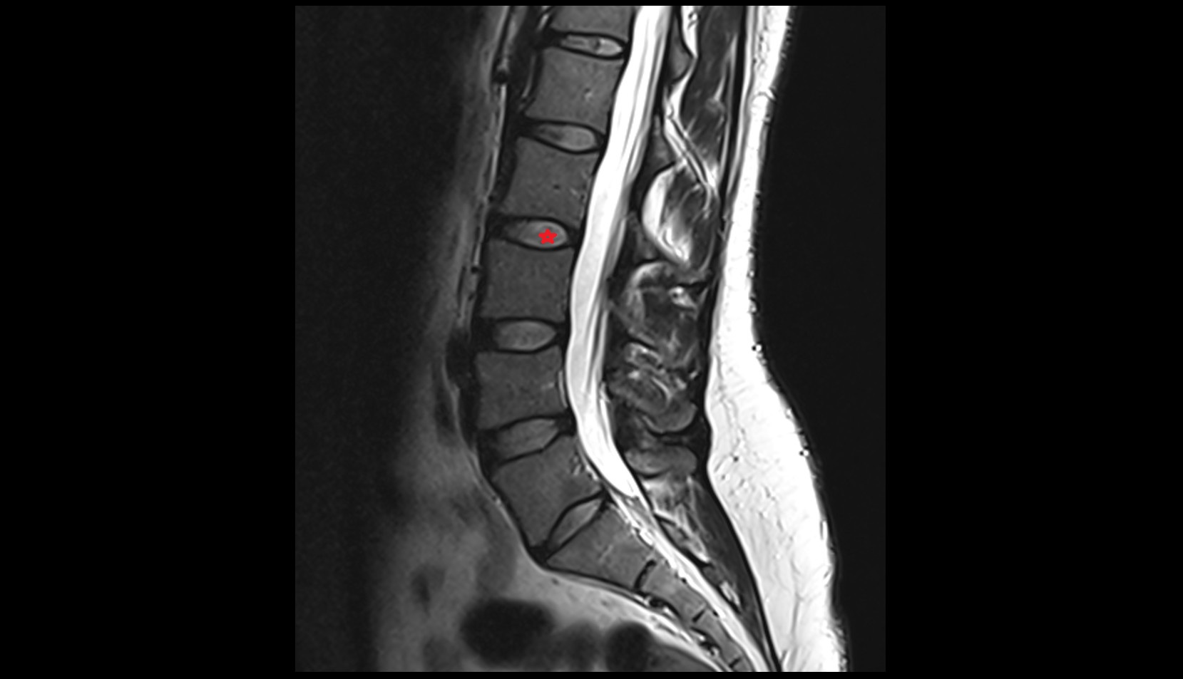 L2–L3 Intervertebral Disc mri anatomy  image