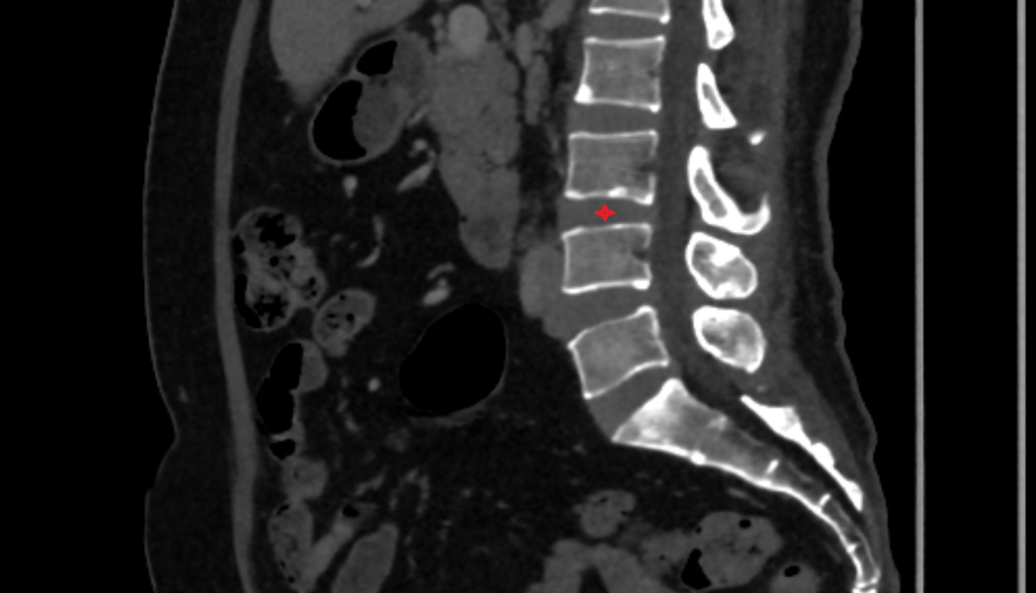 L3–L4 Intervertebral Disc  CT sagittal  anatomy  image-img-00000-00000