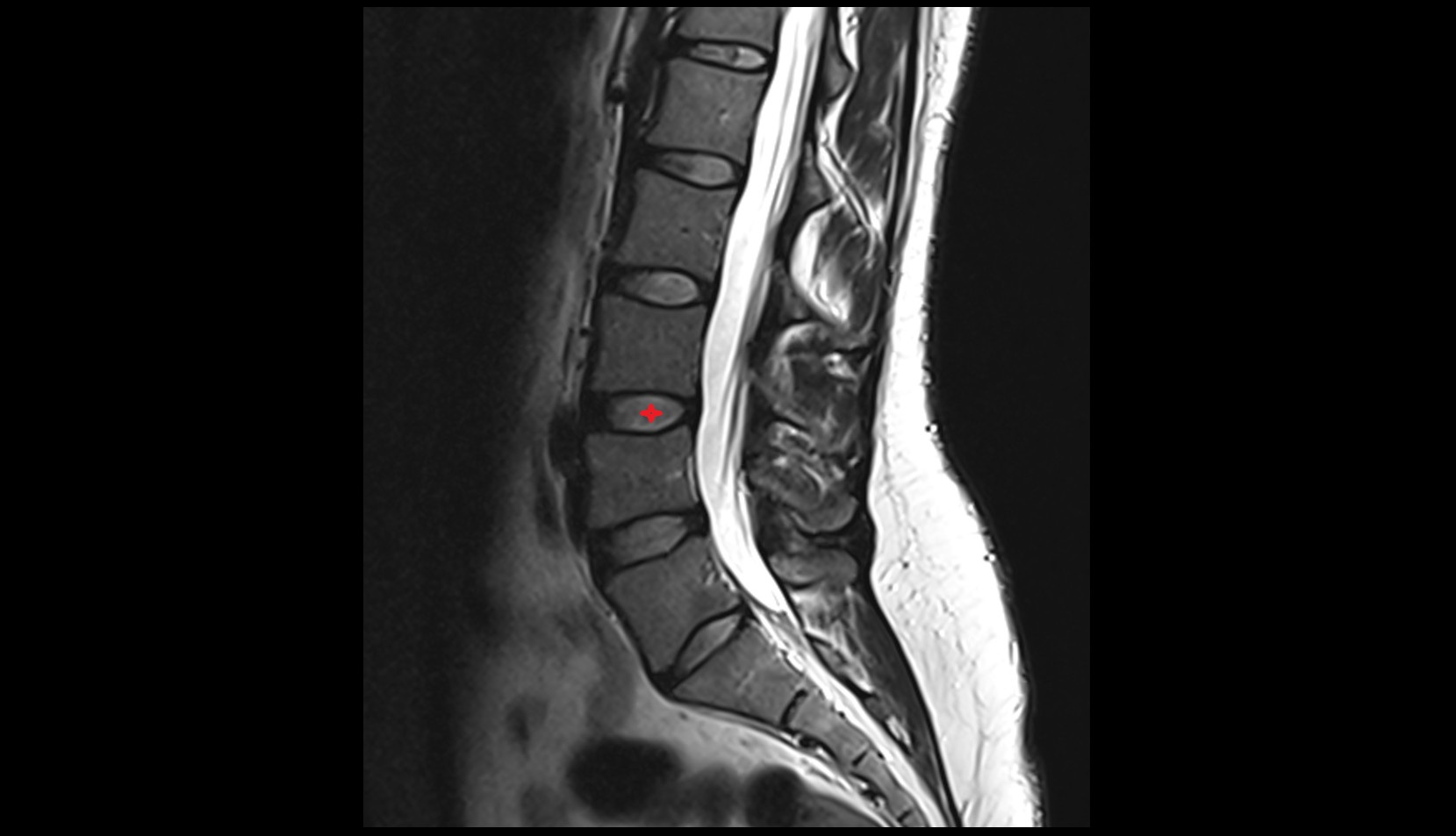 L3–L4 Intervertebral Disc mri anatomy  image