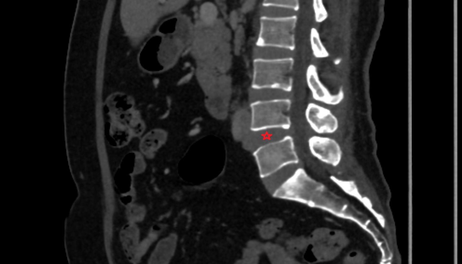 L4–L5 Intervertebral Disc  CT sagittal  anatomy  image-img-00000-00000