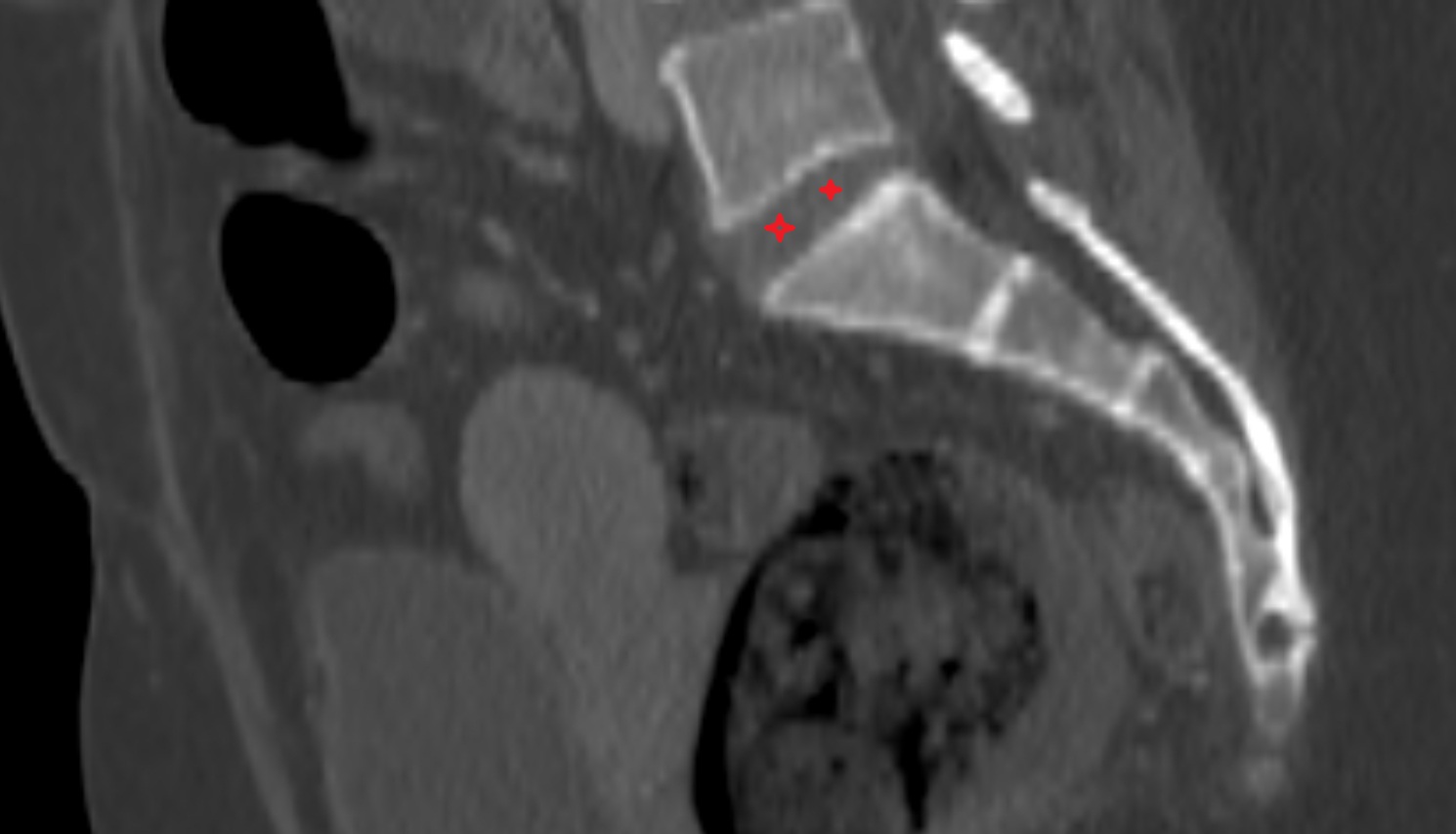 L5–S1 Intervertebral Disc  ct  coronal  anatomy  image-img-00000-00000